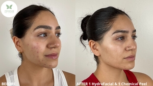 B&A 1 HydraFacial & 1 Chemical Peel-before