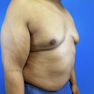 Lipo w Renuvion #9-after