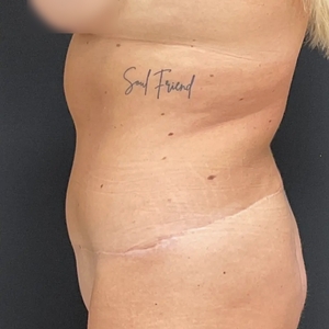 Tummy Tuck #10-after