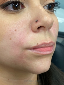 Whitney Devall RN. - Versa-before