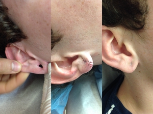 Gauged Earlobe Repair-before