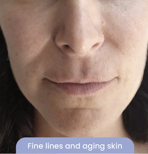 Fine Line & Aging Skin-before