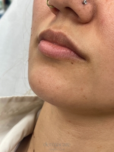 Danielle Glass RN. - Versa-before