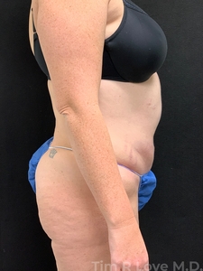 Abdominoplasty - Traditional-before