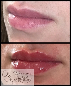 Restylane Kysse Lips-after