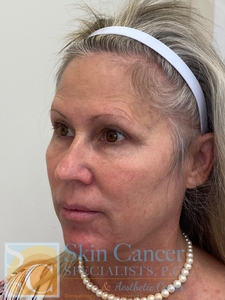 Lower Face Nova Threads-after