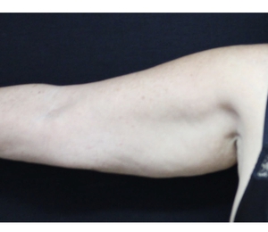 Arm Contouring-after