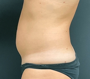 Liposuction #2-before