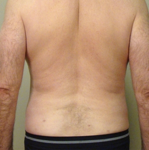 Liposuction #3-after