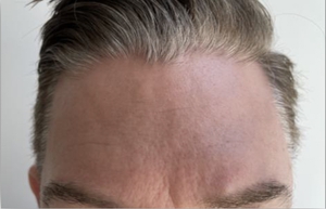 Dry, dehydrated skin-before