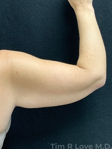 Brachioplasty-before