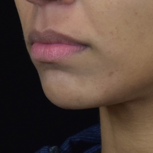 Chin Filler-before