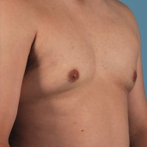 Male Breast Reduction #12 (right oblique)-after
