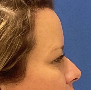 Brow & Eye Lift #2-before
