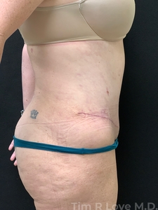 Abdominoplasty - Traditional-after