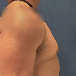 Male Breast Reduction #4-before