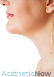 Kybella #2-after