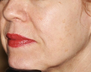 Skin Tone & Texture-before