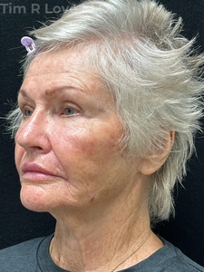 1 year post op short scar face lift and upper lip lift, MyEllevate, Facetite, Morpheus8 x2, Sculptra x4 vials, 1 syringe of Restylane Kysse in lips-after