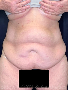 16 WEEKS POST TREATMENT-after