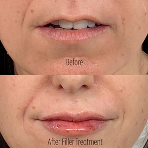 Filler B/A SBA 18-before