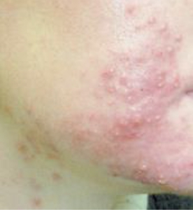 Acne-before