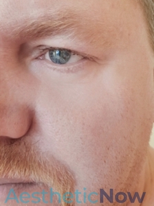 Laser Resurfacing-after