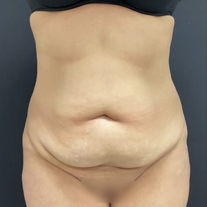 Tummy Tuck #13-before