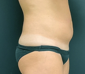 Liposuction #2-before