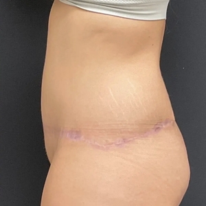 Tummy Tuck #7-after