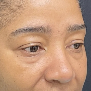 Brow & Eye Lift #3-before