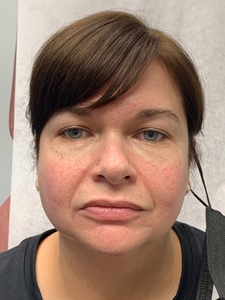 Lip Filler Versa-before