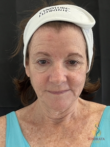 XERF one treatment-before