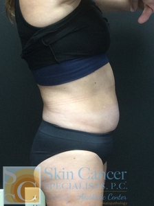 1 Treatment of Coolsculpting-before