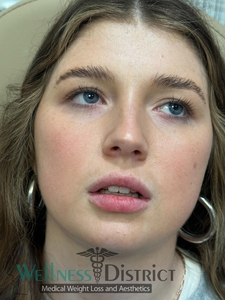 Before and three weeks healed-before