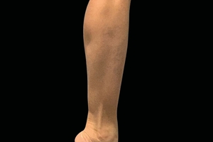 4 Treatments-before