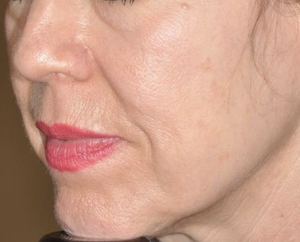 Skin Tone & Texture-after