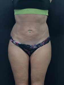 LAL-central abdomen + waist-before