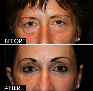 Upper & Lower Blepharoplasty-before