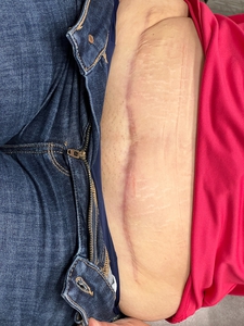 after 1 treatment of PDL-after