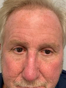 PIQO4 Lentigos-after