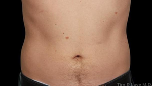 Liposuction - Abdomen-after