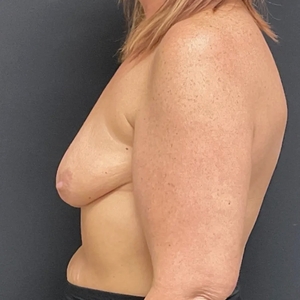 Breast Lift #13 (left)-before