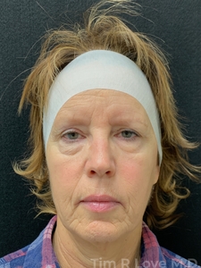 11 months post Morpheus8/Nanofat x3, Sculptra, 1 syringe Versa filler-before