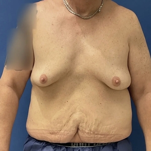Tummy Tuck #9-before