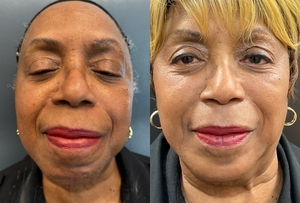 chin filler #voluma #megan-before