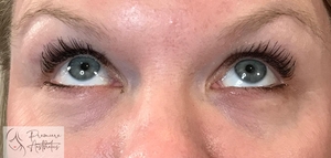 Restylane Filler Microcannula Technique-after