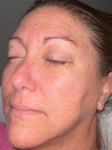 age spots/telang-after