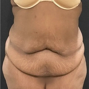 Tummy Tuck #18 (front)-before