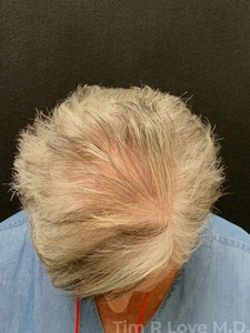 2500 Hair Grafts-after